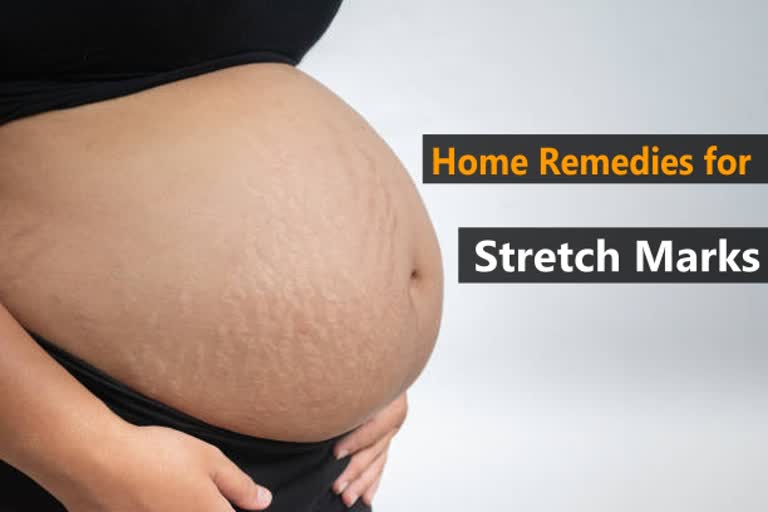 How to Get Rid of Stretch Marks these home remedies can help you to get rid of Stretch marks