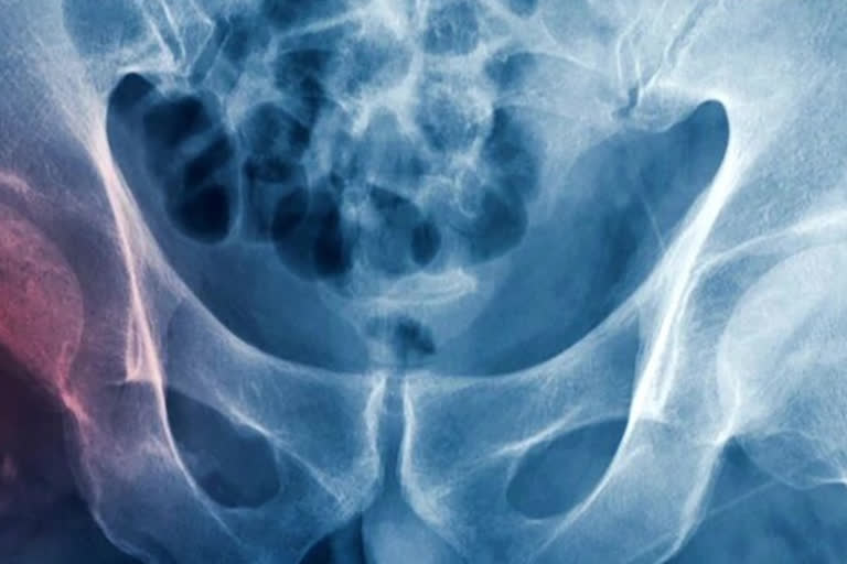 People suffering fractures in childhood vulnerable to breaking bones in old age, study finds