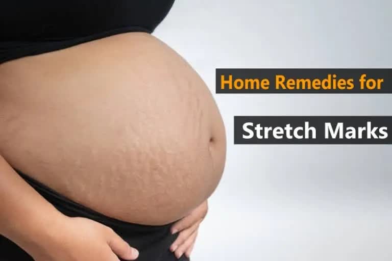 Stretch Marks News