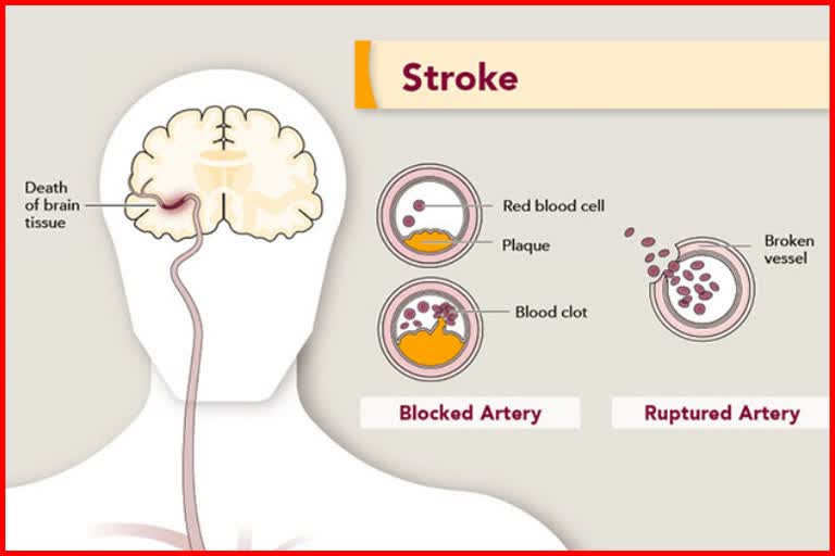 Brain stroke