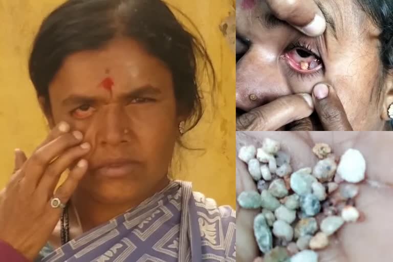 stones coming from woman eyes