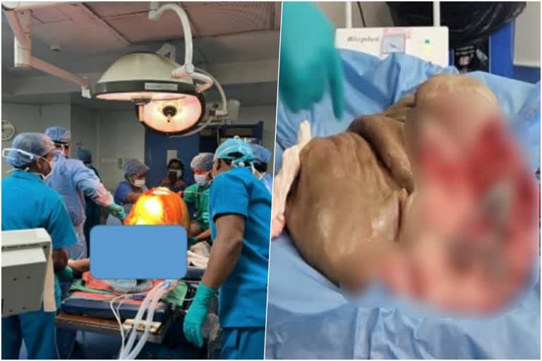 46 KG Tumor removed by doctors from a 61 year old lady at a Private Cancer Hospital in Kolkata