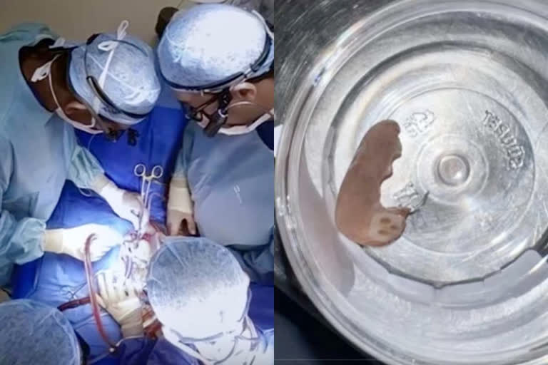 ARTIFICIAL TOOTH REMOVED FROM HEART