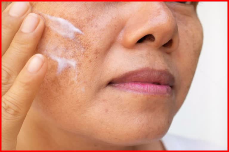 Pigmentation Home Remedy