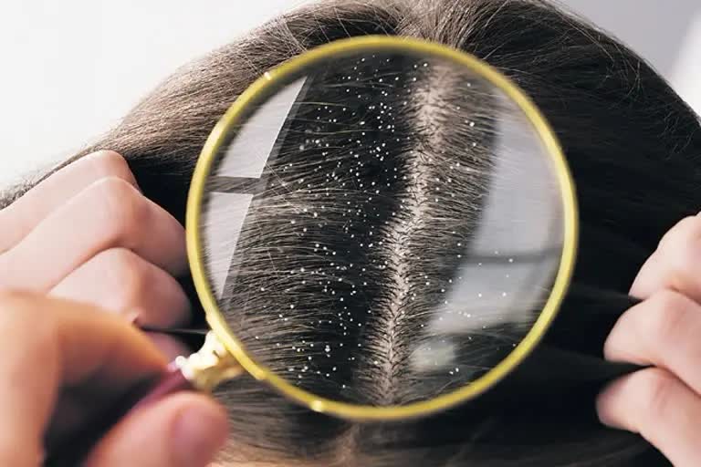 Suffering Dandruff News