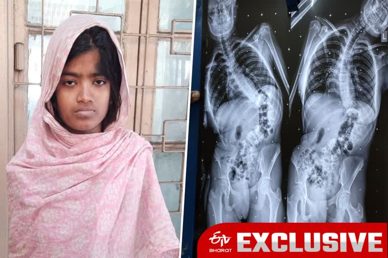 Rare Spinal Cord Surgery At NRS ETV Bharat