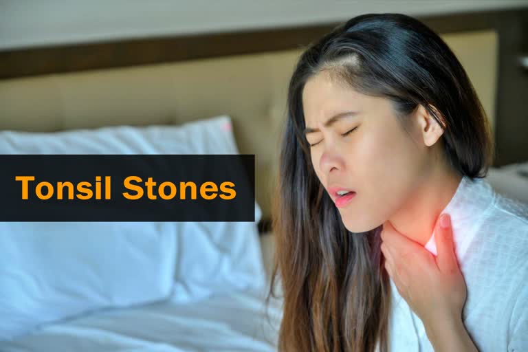 Tonsil stones symptoms treatments and causes