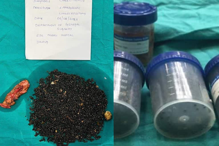 stones removed from gallbladder of a woman in Jaipur