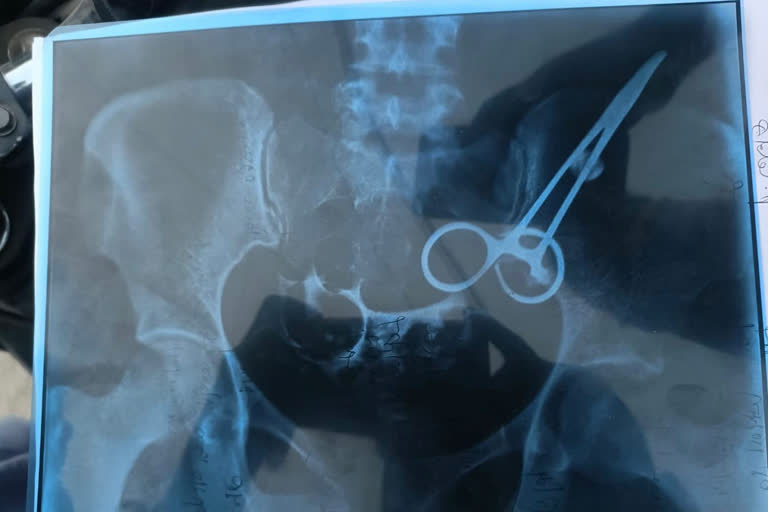 Scissors in woman stomach for six years