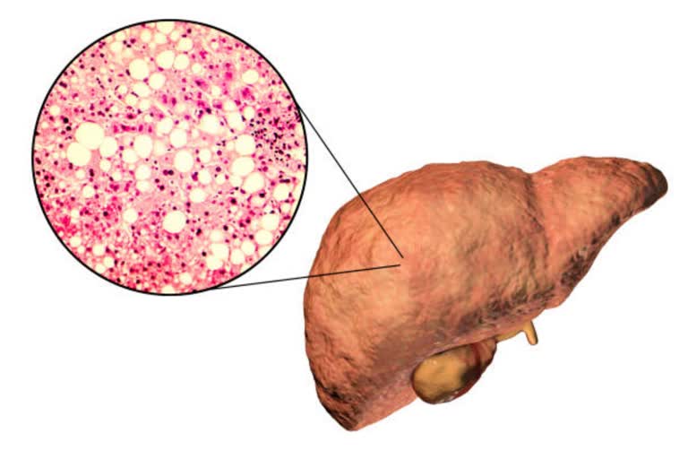 Fatty Liver