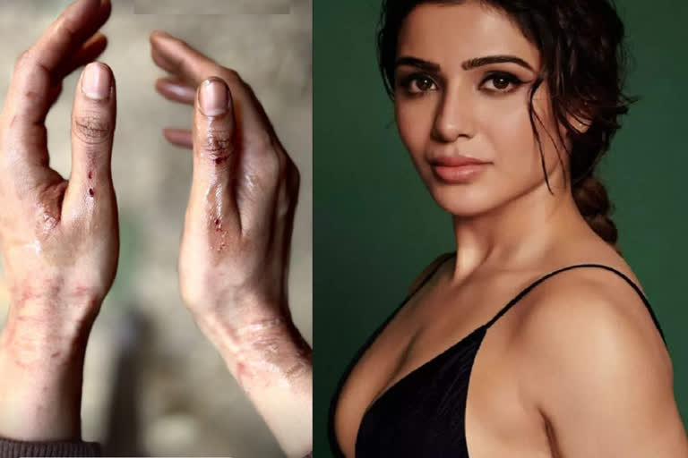 Samantha Ruth Prabhu Injured