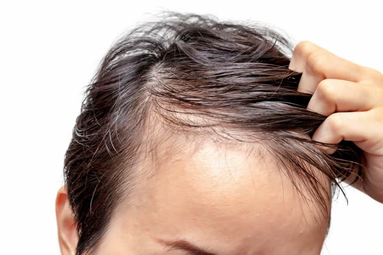 These are the 10 reasons behind hair loss in men