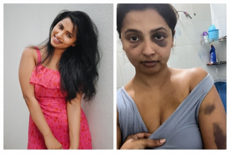 Malayalam actress Anicka Vijayi Vikramman shares bruised pictures after attack by ex-boyfriend