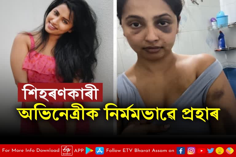 Malayalam actress Anicka Vijayi Vikramman shares bruised pictures after attack by ex-boyfriend