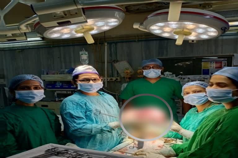 Fibroid Tumor Removed