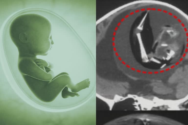 fetus removed from brain from 1 year-old girl  in china