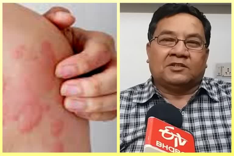 Treatment of Urticaria in Homeopathic