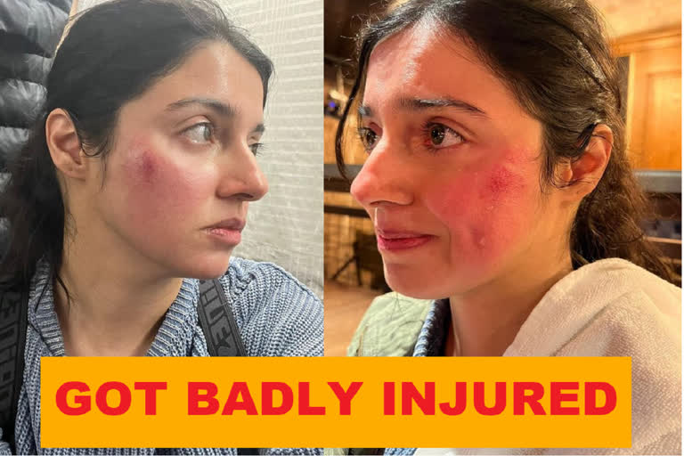 Divya Khosla Kumar injured