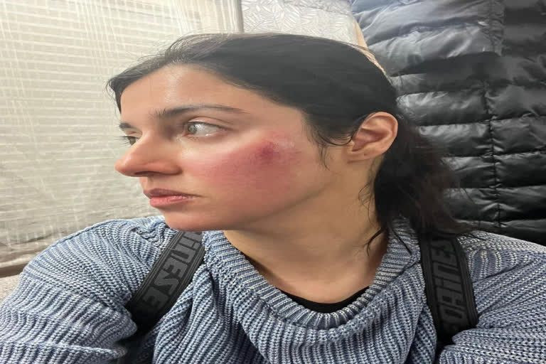 Divya Khosla Kumar shares her injured face