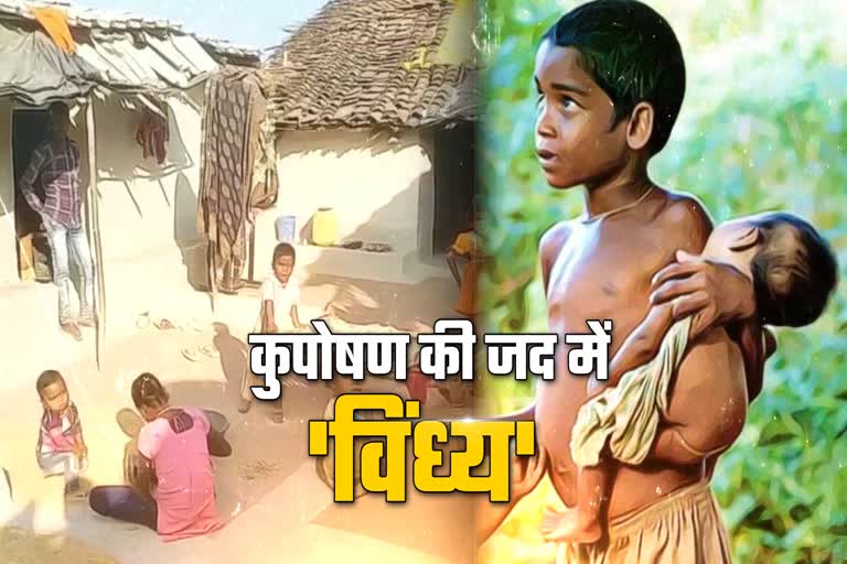 children malnourished in satna