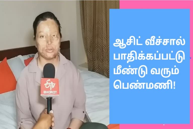 ஆசிட் வீச்சால் பாதிக்கப்பட்ட பெண்