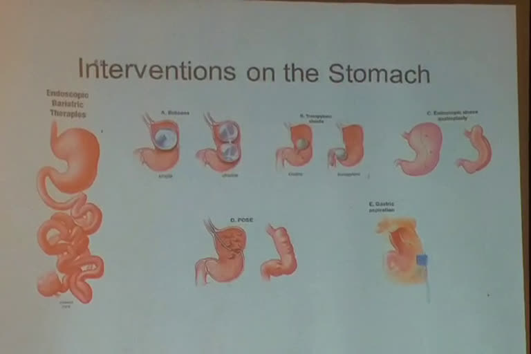 Surgery to reduce obesity in chandigarh