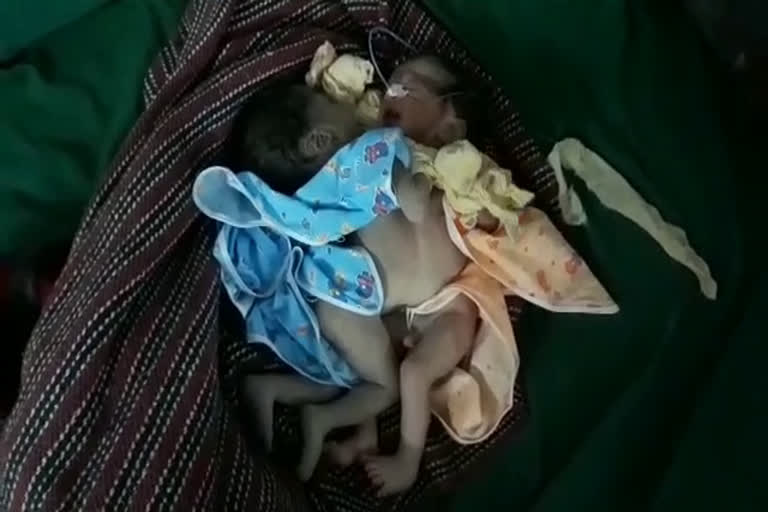 2 inter connected children separated, AIIMS शिशुरोग विभागाध्यक्ष डॉ. अरविंद सिन्हा