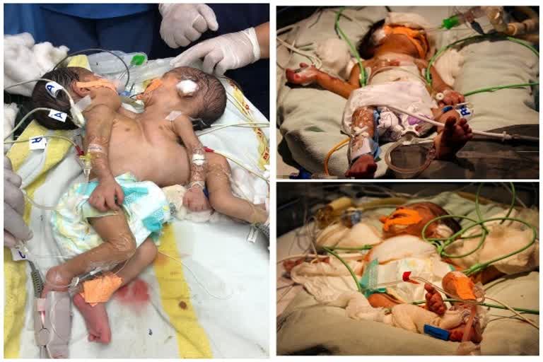 Doctors successfully separate conjoined twins