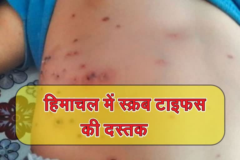 First case of scrub typhus in himachal, हिमाचल में स्क्रब टाइफस का पहला केस