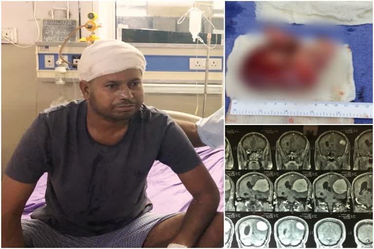 कोटा में ट्यूमर का ऑपरेशन, Tumor operation in Kota