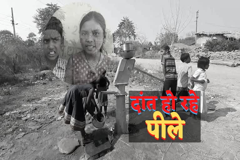 childrens-teeth-become-yellow-due-to-drinking-iron-water-in-dhamtari