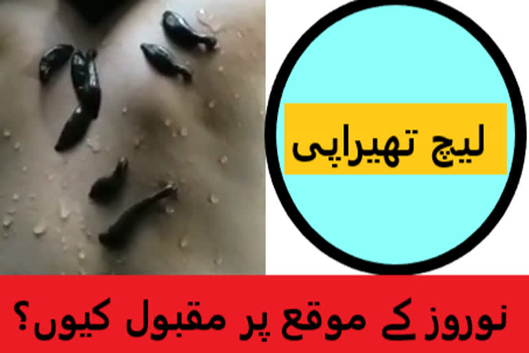 leech therapy is effective on nowroz