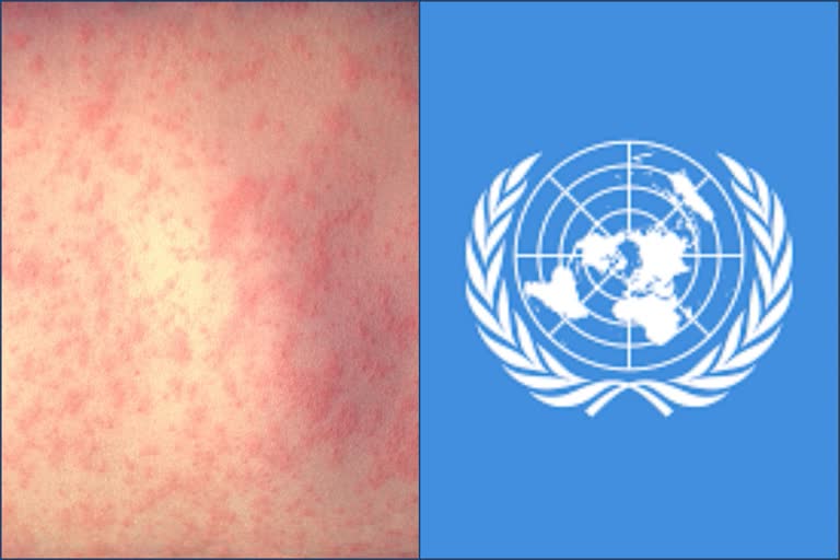 117 million children face measles risk from COVID-19 response: UN