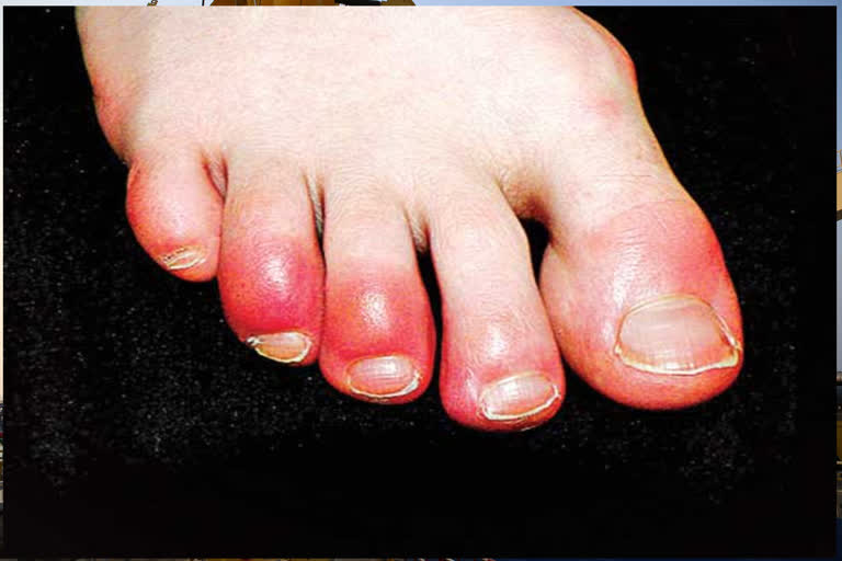 The problem of toes is a corona symptom