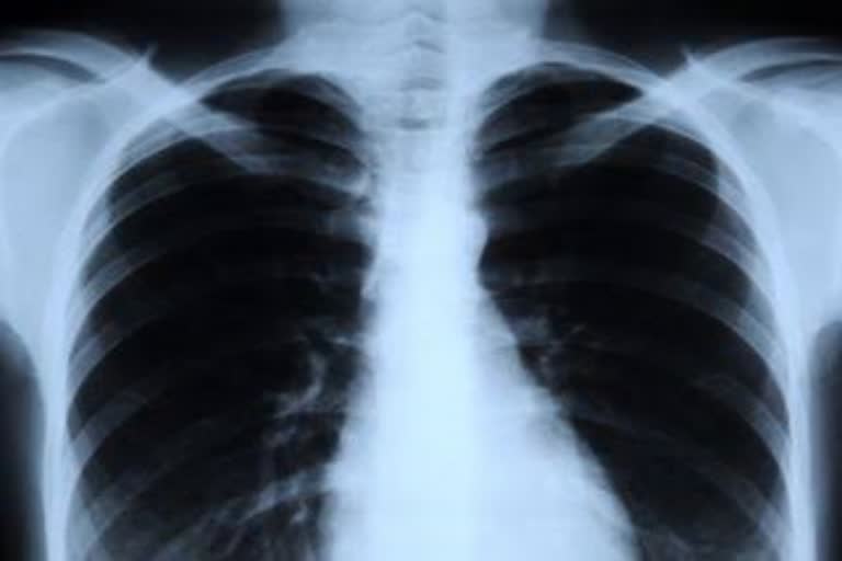 chest x-ray