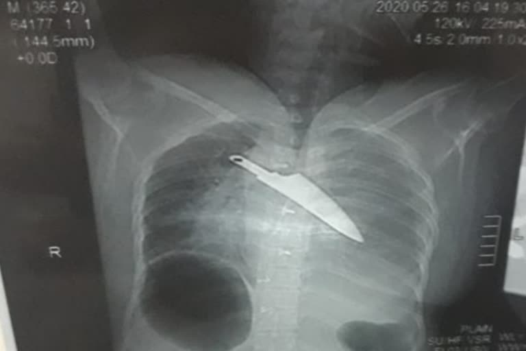 A knife recovered from women's chest