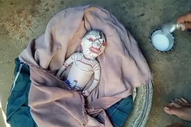 UP woman gives birth to baby with rare genetic skin disorder