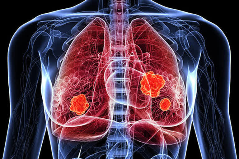 Asia's first bilalteral lung transplantion on a COIVID patient performed in Chennai