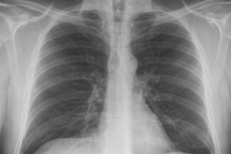 chest x-ray can tell patient is covid positive or not