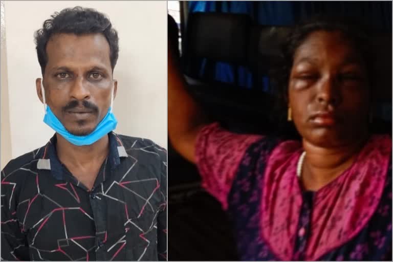 Dakshina Kannada: Acid attack on wife by husband....wife died