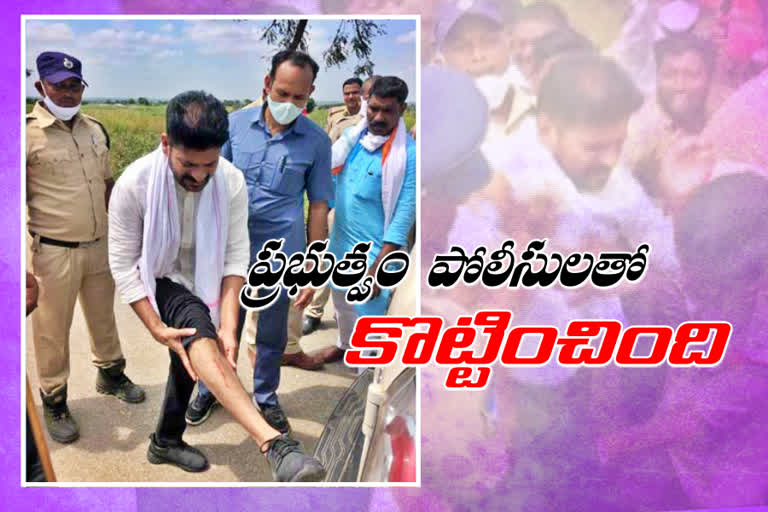 Rewanth Reddy was injured in the leg in Kalvakurthi