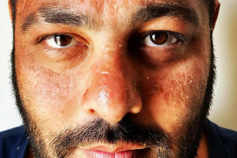 Badshah suffers sunburn while holidaying in Maldives