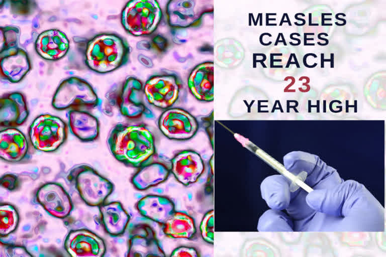 Measles cases reach 23-year high, with infections hitting 870,000  Measles cases  infections hitting 870,000  ലോകത്ത് അഞ്ചാം പനി ബാധിതരുടെ എണ്ണത്തിൽ വർധന  അഞ്ചാം പനി ബാധിതരുടെ എണ്ണത്തിൽ വർധന  അഞ്ചാം പനി ബാധ