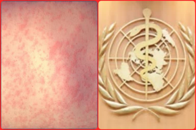 Measles pandemic will be outbreak to next year: Kim Mulholland