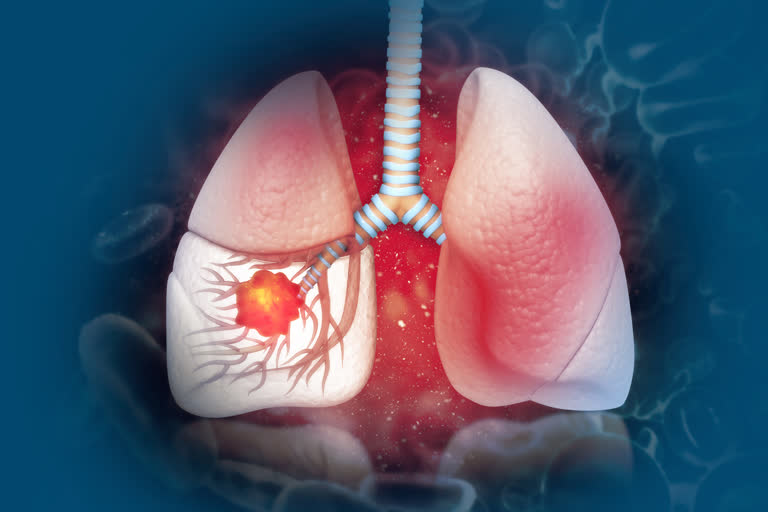 non smokers lung cancer, lung cancer in non smoking female, lung cancer north India