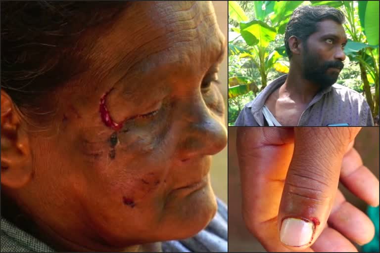 ചെന്നായയുടെ ആക്രമണം  wolf attack in kozhikode  ചെന്നായയുടെ ആക്രമണത്തിൽ പരിക്ക്  കാരശേരി  Four injured in wolf attack