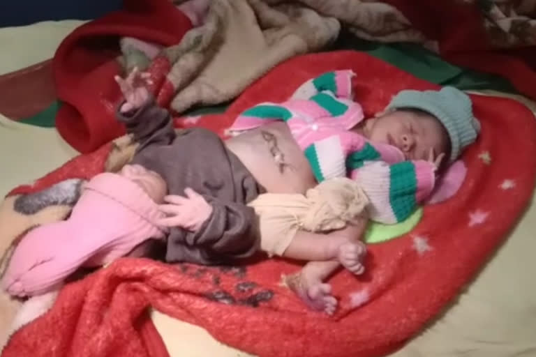 Aligarh woman births a baby with two heads, four hands