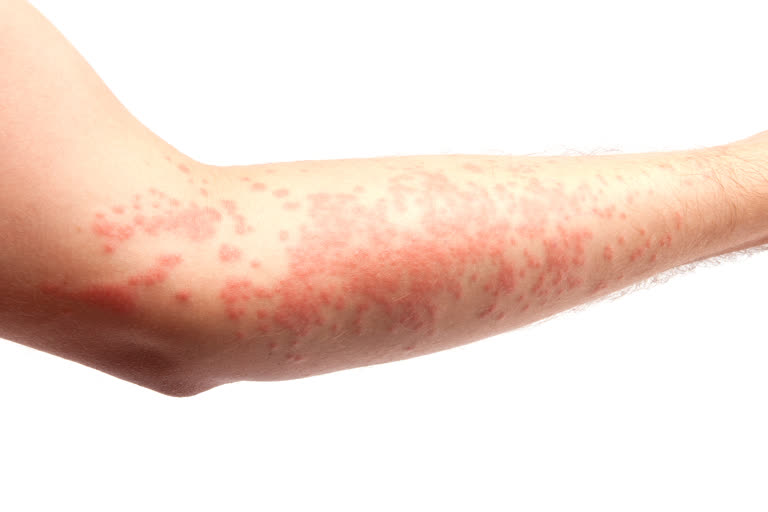 complications of urticaria