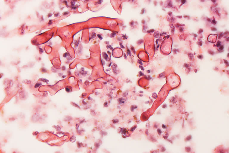 Mucormycosis