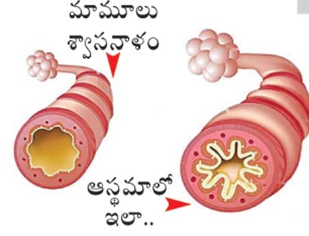 A special story on Asthma and its diagnose Methods